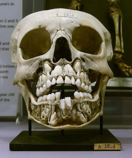 El cráneo de un niño con dientes de leche y permanentes es escalofriante